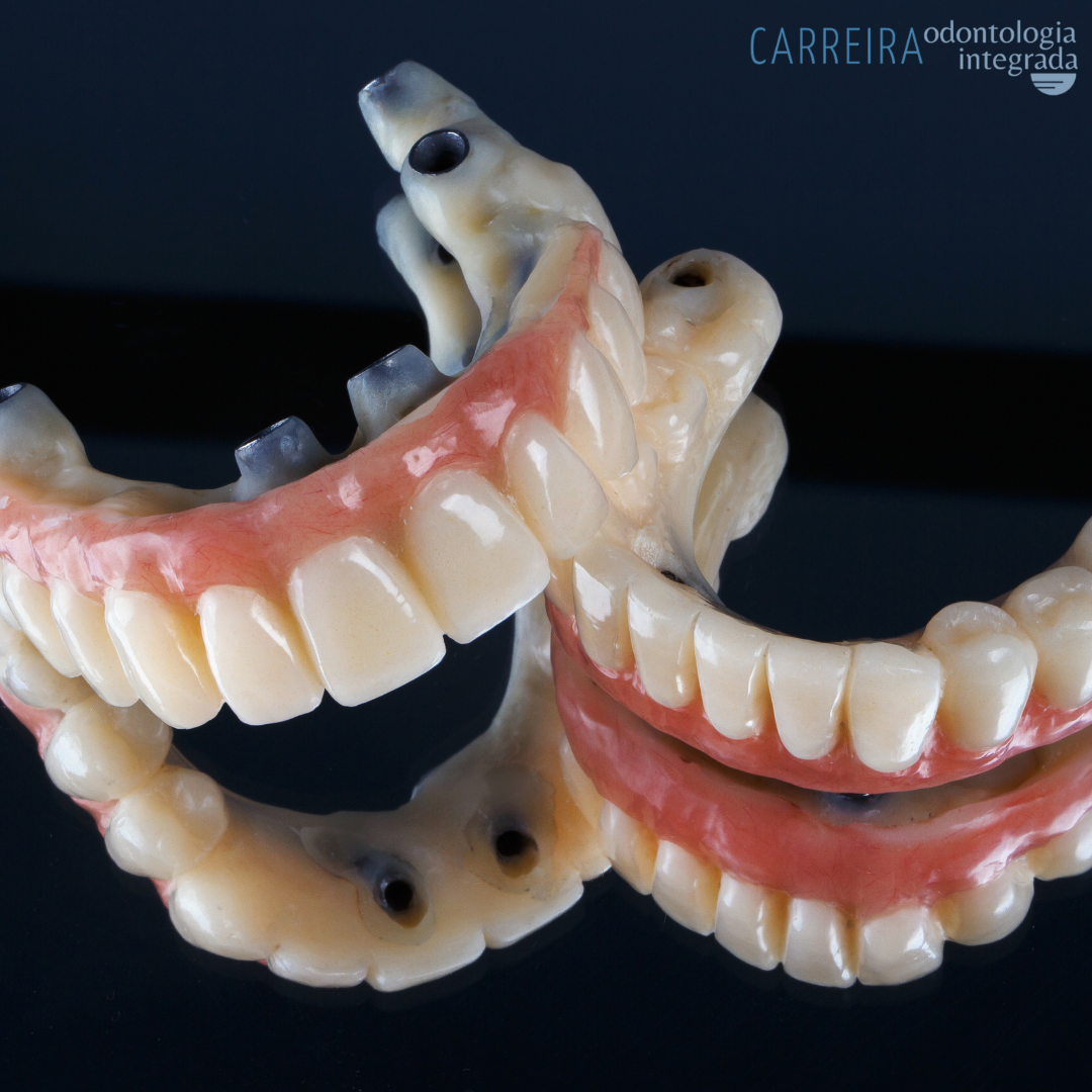 Dentadura Fixa (Prótese Protocolo): Preço, Tipos, Vantagens e Cuidados Essenciais