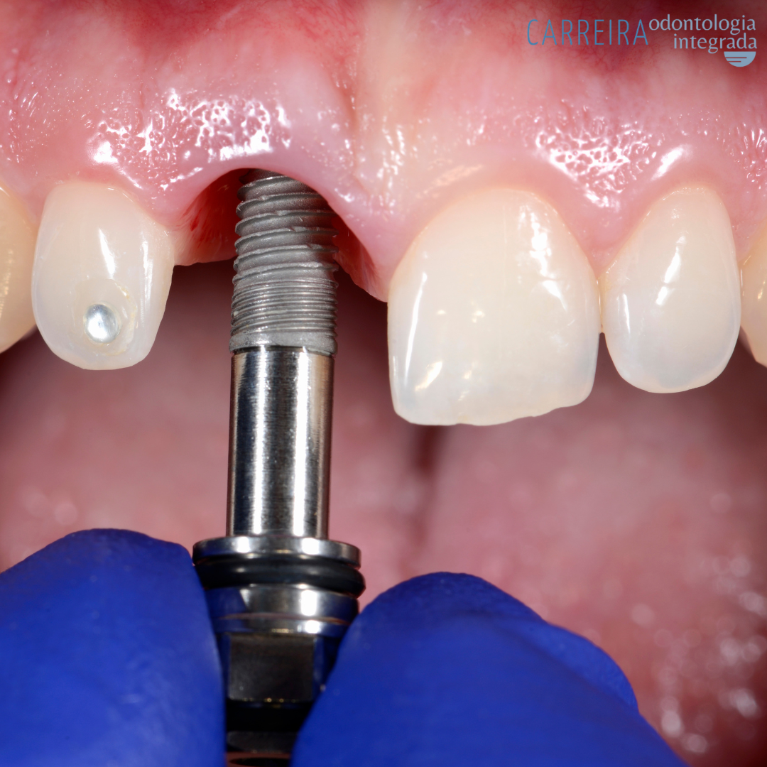 Implante Dentário: Preço, Riscos, Vantagens e Diferença em Relação à Prótese